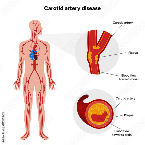 Carotid artery disease Signs of Carotid Artery Disease medical illustration diagram