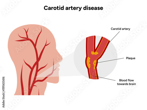 Carotid artery disease Signs of Carotid Artery Disease medical illustration diagram