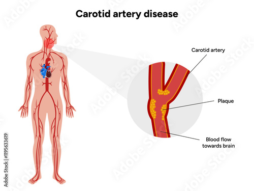 Carotid artery disease Signs of Carotid Artery Disease medical illustration diagram