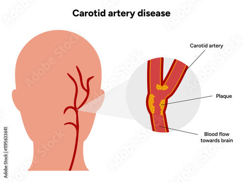 Carotid artery disease Signs of Carotid Artery Disease medical illustration diagram