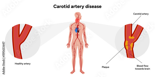 Carotid artery disease Signs of Carotid Artery Disease medical illustration diagram