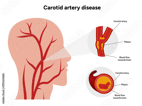 Carotid artery disease Signs of Carotid Artery Disease medical illustration diagram