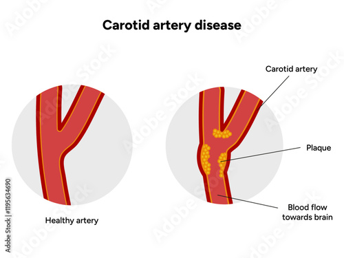 Carotid artery disease Signs of Carotid Artery Disease medical illustration diagram