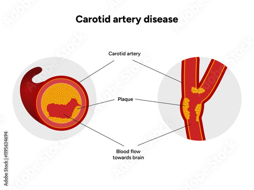 Carotid artery disease Signs of Carotid Artery Disease medical illustration diagram