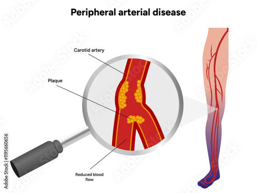 Peripheral Arterial Disease Daily Life and Mobility medical illustration 