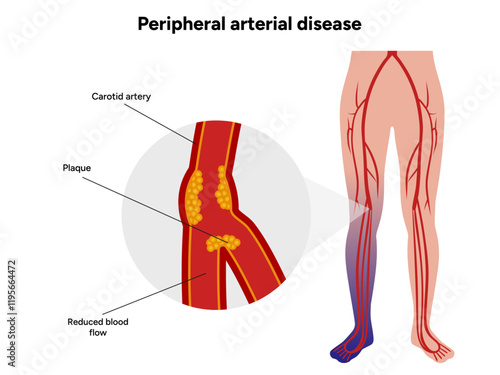 Peripheral Arterial Disease Daily Life and Mobility medical illustration 