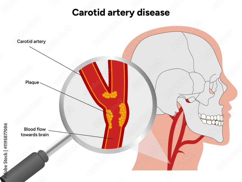 Plakát Carotid artery disease Signs of Carotid Artery Disease medical ...