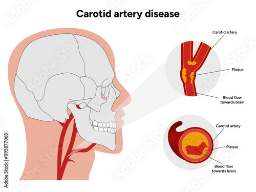 Carotid artery disease Signs of Carotid Artery Disease medical illustration diagram