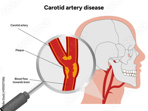 Carotid artery disease Signs of Carotid Artery Disease medical illustration diagram