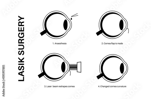 LASIK eye surgery