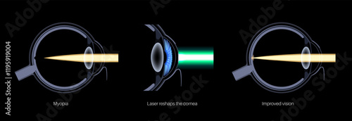 LASIK nearsightedness treatment