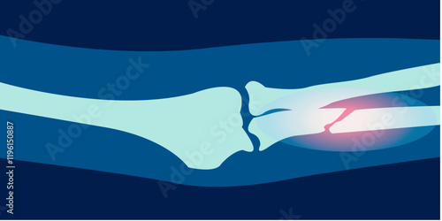 X ray image of forearm fracture ilustration. 2D Picture rontgen of arm bone in painful injury damage. Vector illustration.