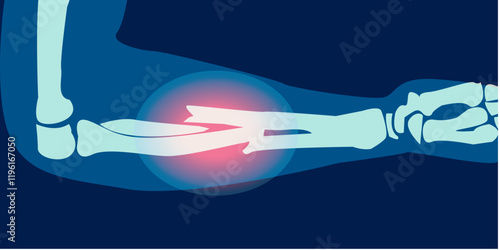 X ray image of forearm fracture ilustration. 2D Picture rontgen of arm bone in painful injury damage. Vector illustration.