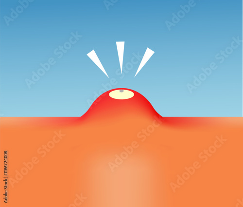 Acne on the face. Acne illustration vector