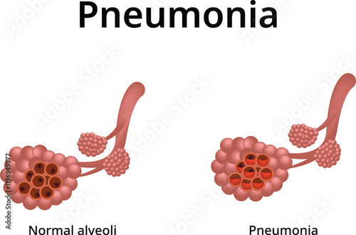 Pneumonia Design Vector Illustration