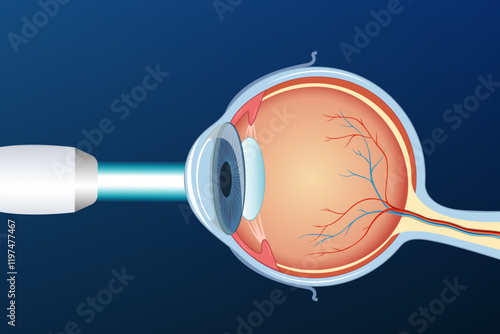 Eye with glaucoma, medical infographics with the anatomy of the human eye optics. Laser eye surgery LASIK