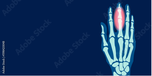 X-ray image of hand finger pain illustration. 2D illustration picture rontgen of finger bone. Vector design.