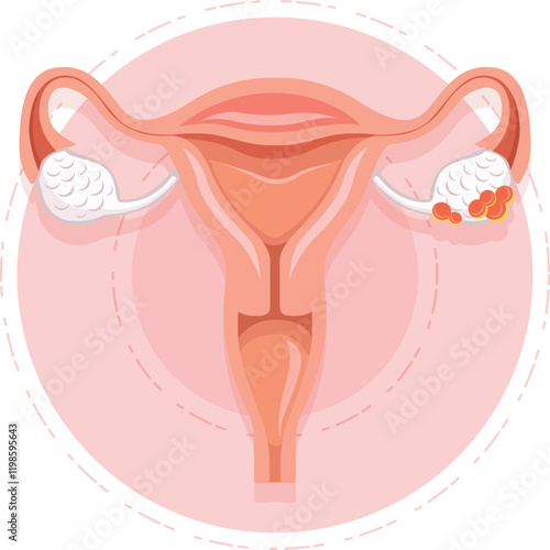 Ovary Cancer Vector