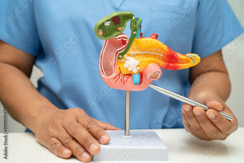 Pancreatitis, pancreatic cancer, Asian doctor with pancreas, gallbladder and bile duct human anatomy model at hospital. photo