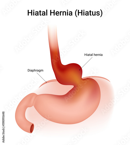 Causes of Hiatal Hernia (Hiatus)