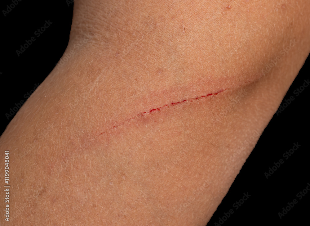 Fototapeta premium A person's arm has a red line on it