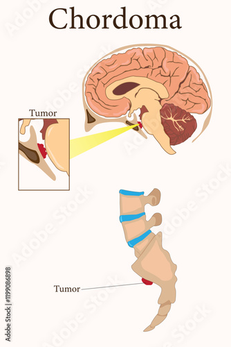 Illustration of chordoma tumors located at the skull base and sacrum in the spine. eps 10