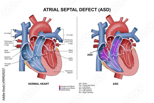 Atrial Septal Defect (ASD) Illustration