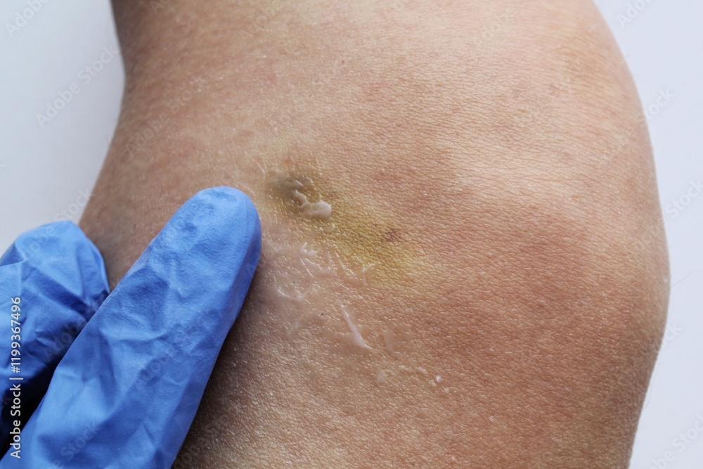 Fototapeta premium A doctor in blue gloves makes cream treatment on bruised leg as result of sport trauma, accident. Bruise on the leg after domestic violence. Hematology problems. Inflammation skin from hematoma