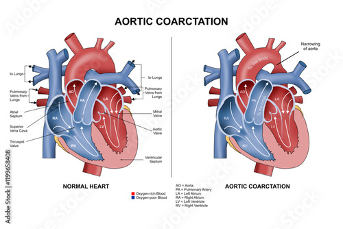 Aortic Coarctation Heart Desease Illustration