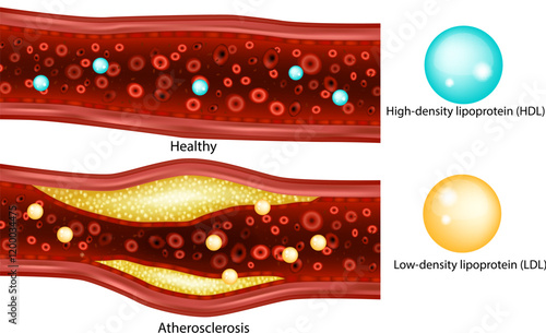 Cholesterol. Low-density lipoprotein (LDL)High-density lipoprotein (HDL). Atherosclerosis, arterial plaque 