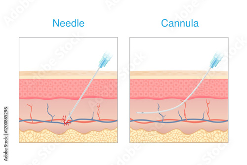 Compare a needle and cannula is equipment of Aesthetic for injecting the skin. Needle punctured blood vessel and lead to a bruise. cannula not penetrating a blood vessel.