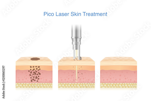 Types of acne scar on facial skin layer. Rolling, Boxed and Icepick scars isolated white background. 3D vector Medical diagram about skin problem from acne.