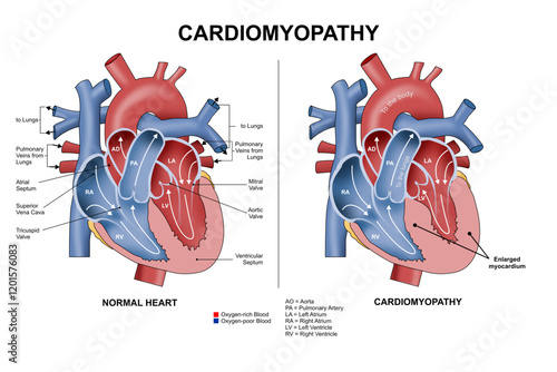Cardiomyopathy Heart Disease Illustration Cross section