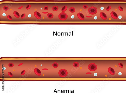Normal Anemia Design Vector Illustration