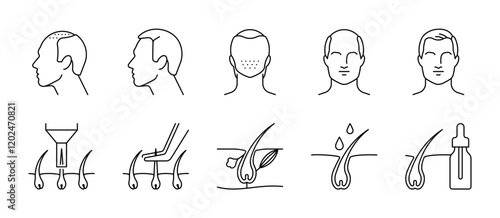 Hair grafts. Hair transplantation issue, icon set - bald man, bald head, baldness, follicle, extraction, implanter pen, growth, hair serum. Linear illustration, editable stroke icon