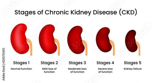 Stages of Chronic Kidney Disease (CKD)