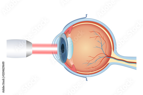 The process of laser eye surgery LASIK. Vision correction for nearsightedness, farsightedness, and astigmatism
