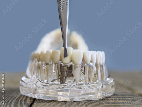 Close-up of a dental implant model with a denture being adjusted with a dental instrument for educational and demonstration purposes