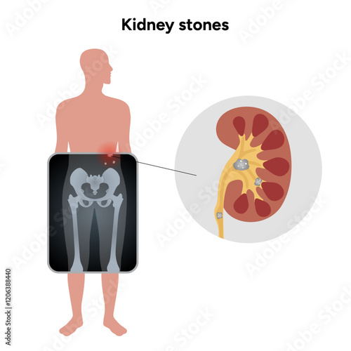 Human urine pain, diagnosis ureter, kidney stones in x ray. Urologist medical disease 