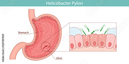 Green bacterium Helicobacter pylori. stomach disease. Vector illustration in cartoon style.