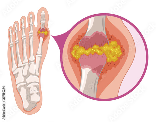 Gout diagram in human foot with crystallization of uric acid joint. Medical educational poster infographic scheme with inflammatory arthritis. Orthopedic disease vector illustration