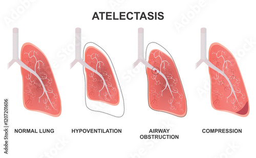 Atelectasis lung diseases illustration types