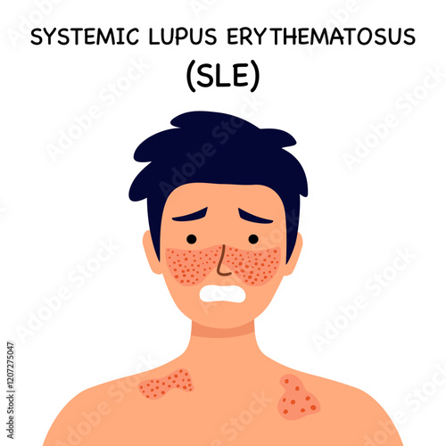 Systemic lupus erythematosus. Guy with the typical butterfly rash in lupus. SLE. skin disease.