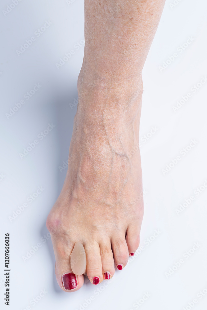 A silicone separator inserted between the big toe and index toe of a foot with hallux valgus A silicone separator inserted between the big toe and index toe of a foot with hallux valgus