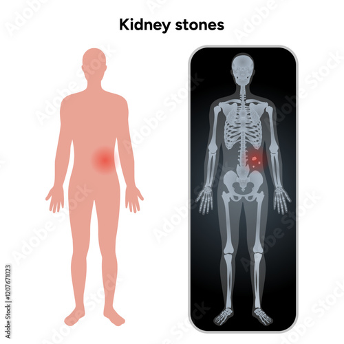 Human urine pain, diagnosis ureter, kidney stones in x ray. Urologist medical disease 