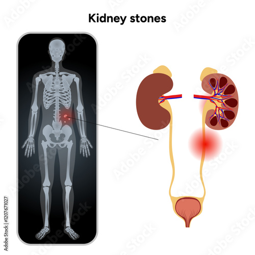 Human urine pain, diagnosis ureter, kidney stones in x ray. Urologist medical disease 