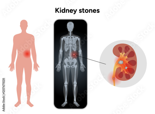 Human urine pain, diagnosis ureter, kidney stones in x ray. Urologist medical disease 