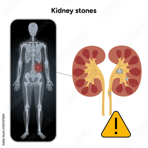 Human urine pain, diagnosis ureter, kidney stones in x ray. Urologist medical disease 