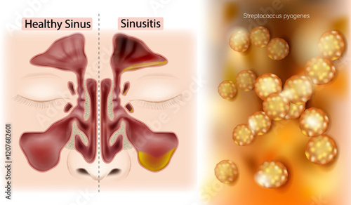 Comparison of Healthy Sinus and Sinusitis with Streptococcus Pyogenes . Sinus Bacterial Infection Concept. Sinus Anatomy and Sinusitis 