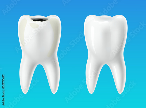Healthy tooth and decayed tooth. 3D isolated teeth, caries professional treatment in stomatology, oral hygiene poster, before and after banner, dentistry advertising vector medical concept